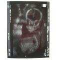 My First Pregnancy