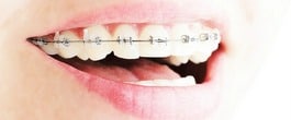 Thumbnail image for 3 Things I Have Learned While Wearing Braces