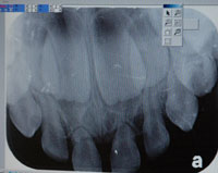 Teeth X-Ray