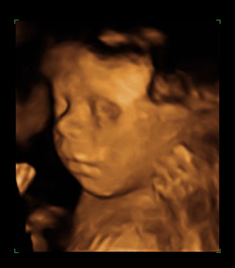 Sophia 3D Ultrasound