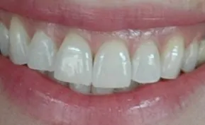 My After Photo – Testing Crest 3D White 2 Hour Express Whitestrips