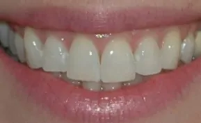 Before 2 Hr Whitening Treatment